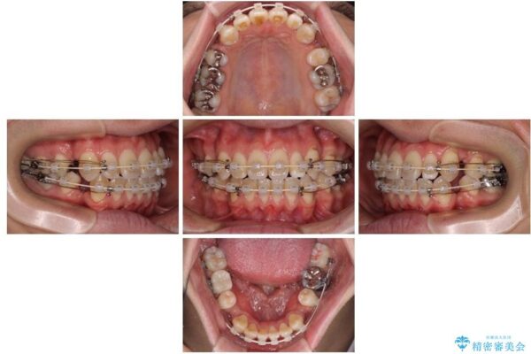 口元の突出感を改善!目立ちにくいワイヤー矯正で自信を持てる自然な横顔に 治療途中画像
