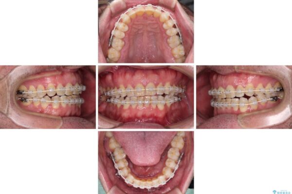 前歯でものを噛みきりたい　目立たない装置でのワイヤー矯正 治療途中画像