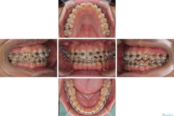 左右の八重歯が気になる　ワイヤー装置での咬み合わせ改善 治療途中画像