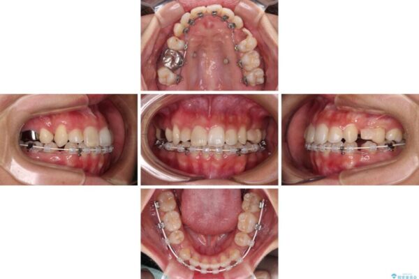 気になる八重歯　目立ちにくいハーフリンガルでの抜歯矯正 治療途中画像