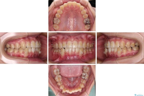 【モニター】下顎前歯のデコボコをインビザラインできれいに 治療途中画像