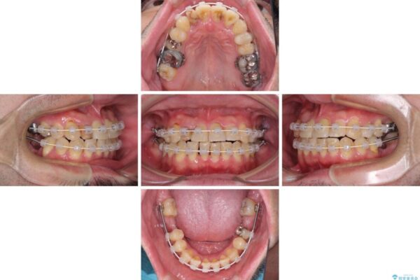 割れてしまった奥歯とデコボコの前歯　矯正治療とインプラント治療 治療途中画像