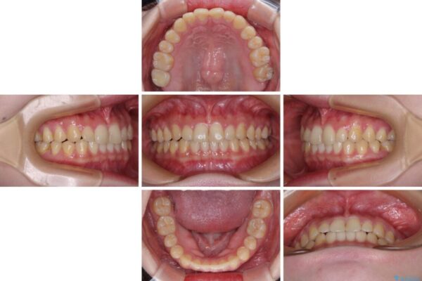 治療途中の奥歯と矯正治療の後戻り　インビザライン・ライトによる矯正治療 治療途中画像