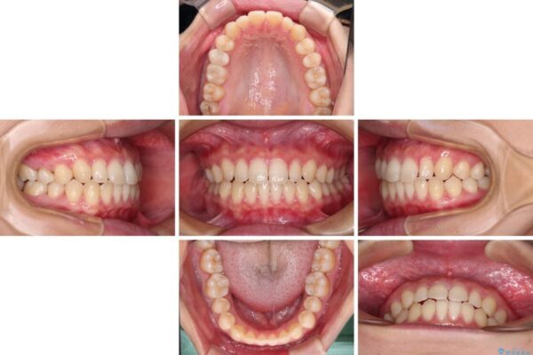 隙間だらけの歯列　インビザラインで改善 治療途中画像