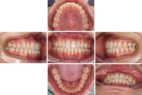 【モニター】前歯のデコボコをインビザラインで改善 治療途中画像