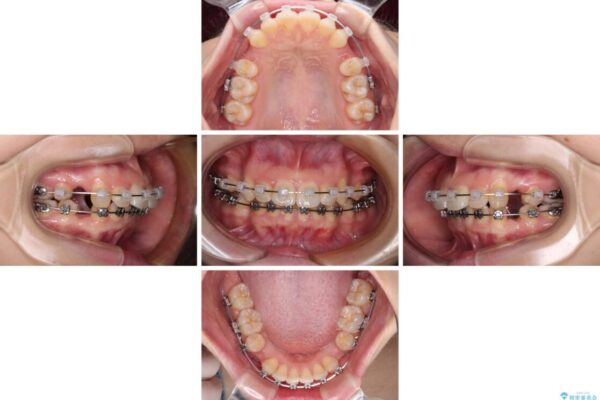 【モニター】口が閉じられない　ワイヤー装置での抜歯矯正 治療途中画像