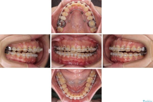 【モニター】飛び出た前歯を整えたい　ワイヤー矯正治療 治療途中画像