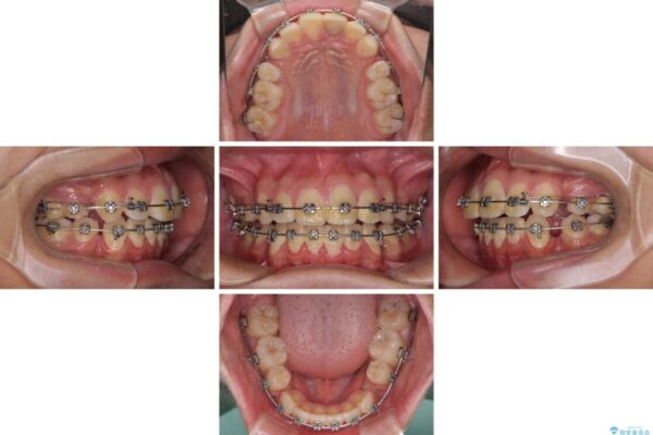 膨らんだ口元　ワイヤー装置での抜歯矯正 治療途中画像