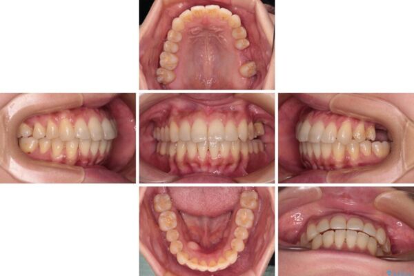 インビザラインによる矯正治療と奥歯のインプラント治療 治療途中画像