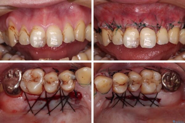 むし歯だらけの前歯をオールセラミッククラウンできれいに 治療途中画像