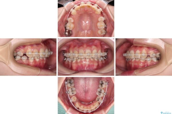 デコボコと深い咬み合わせ　ワイヤー装置での抜歯矯正 治療途中画像