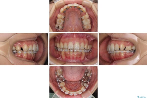 デコボコと口元の突出感　ハーフリンガルでの抜歯矯正 治療途中画像