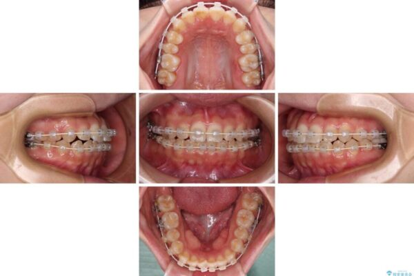 【モニター】短期間で終わりたい　ワイヤー装置での非抜歯矯正 治療途中画像