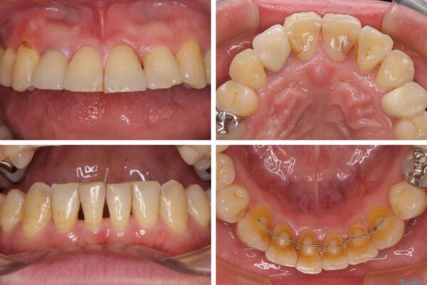 割れてしまった奥歯とデコボコの前歯　矯正治療とインプラント治療 治療後画像