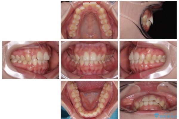 目立ちにくい表側装置で1年完了!狭いアーチを側方拡大し前歯のデコボコを整えた症例 治療前画像