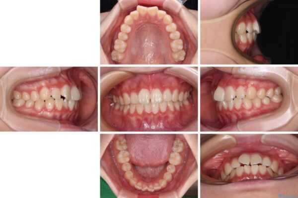 インビザラインは使える自信がない　ワイヤー装置にて矯正治療 治療前画像