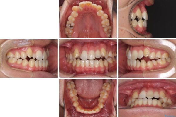 左右の八重歯が気になる　ワイヤー装置での咬み合わせ改善 治療前画像