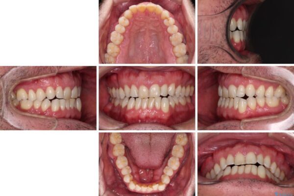 前歯でものを噛みきりたい　目立たない装置でのワイヤー矯正 治療前画像