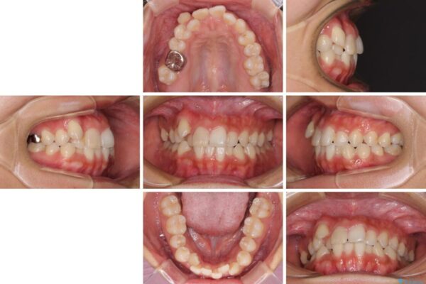 気になる八重歯　目立ちにくいハーフリンガルでの抜歯矯正 治療前画像