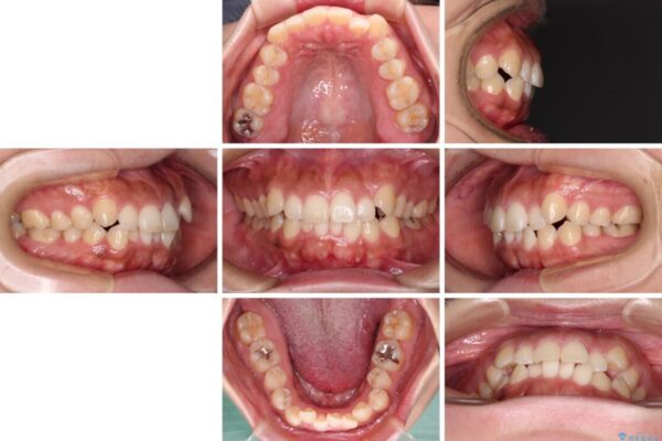 【モニター】カリエール・ディスタライザーを併用した八重歯のインビザライン矯正 治療前画像