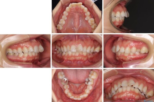 【モニター】出っ歯と咬み合わせを改善　ワイヤー装置の抜歯矯正 治療前画像