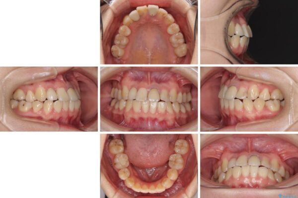虫歯治療ついでに歯並びの後戻りを改善　インビザラインによる矯正治療 治療前画像