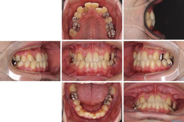 割れてしまった奥歯とデコボコの前歯　矯正治療とインプラント治療 治療前画像
