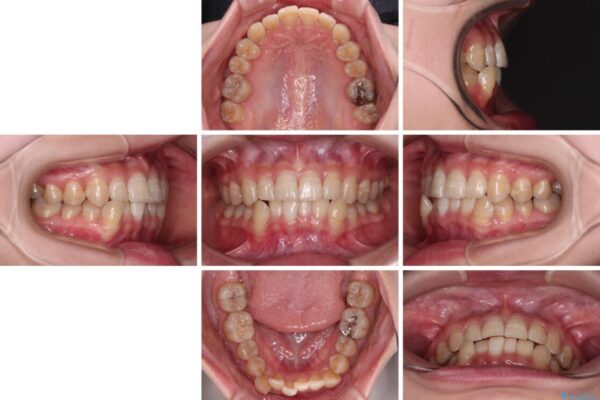 【モニター】下顎前歯のデコボコをインビザラインできれいに 治療前画像