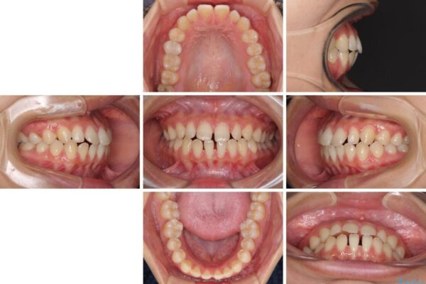 隙間だらけの歯列　インビザラインで改善 治療前画像
