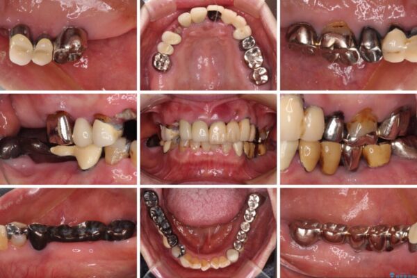 前歯をきれいにしたい　インプラントや部分矯正を用いた総合歯科治療 治療前画像