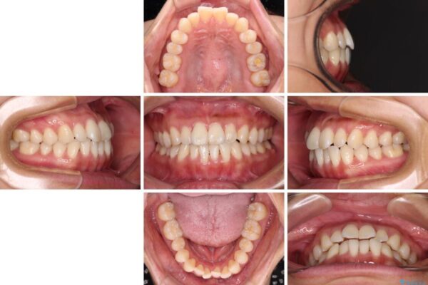 【モニター】前歯のデコボコをインビザラインで改善 治療前画像
