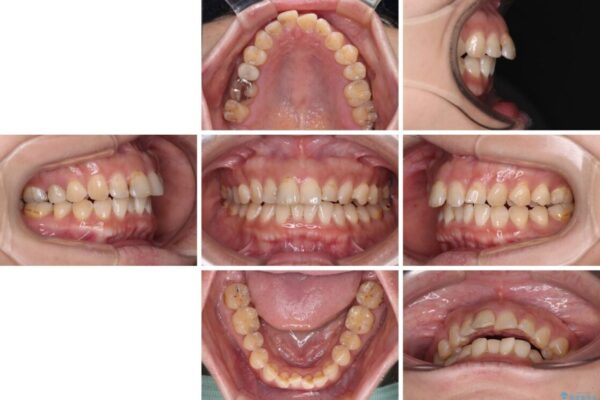 【モニター】飛び出た前歯を整えたい　ワイヤー矯正治療 治療前画像