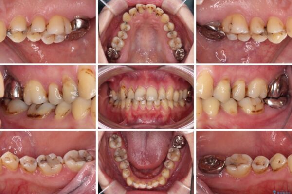 むし歯だらけの前歯をオールセラミッククラウンできれいに 治療前画像