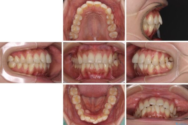 インビザラインによる矯正治療と奥歯のインプラント治療 治療前画像