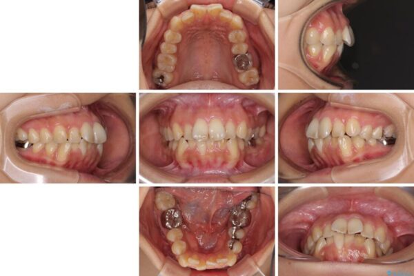 デコボコと口元の突出感　ハーフリンガルでの抜歯矯正 治療前画像
