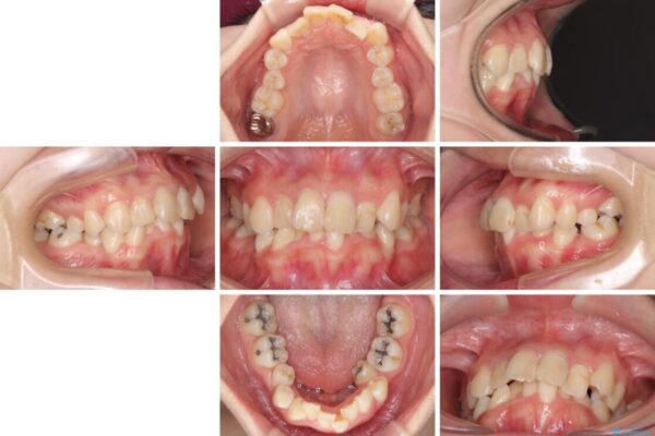 デコボコと深い咬み合わせ　ワイヤー装置での抜歯矯正 治療前画像
