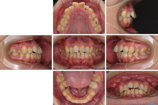 後戻りでデコボコの前歯　インビザライン矯正治療 治療前画像