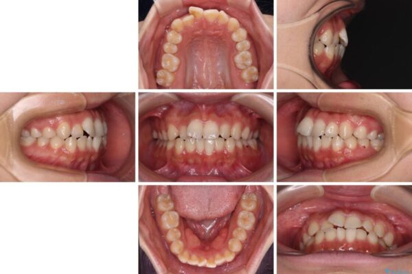 【モニター】短期間で終わりたい　ワイヤー装置での非抜歯矯正 治療前画像
