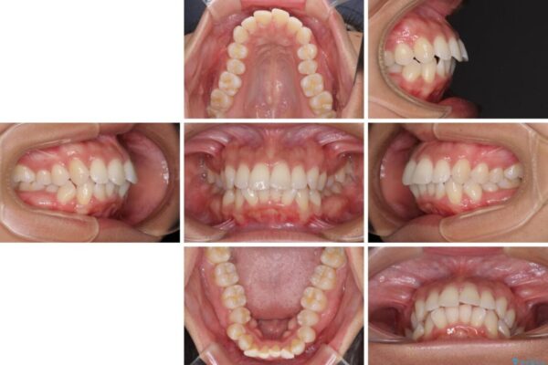 抜歯矯正で唇を閉じやすく　目立たないワイヤー装置 治療前画像
