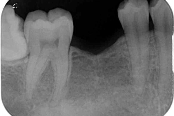 空いている時間を利用して通院　奥歯のインプラント治療 治療前画像