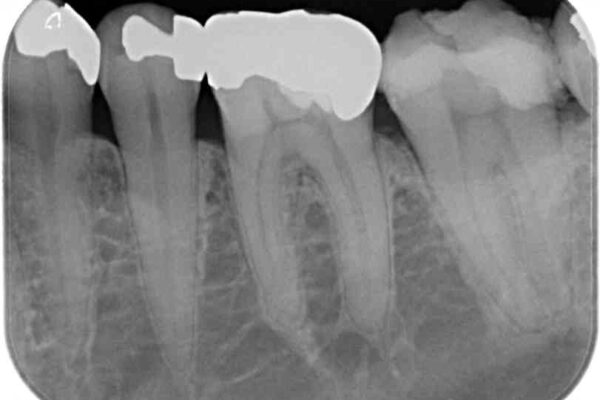 治療をしても違和感の続く奥歯　神経を極力残した虫歯治療 治療前画像