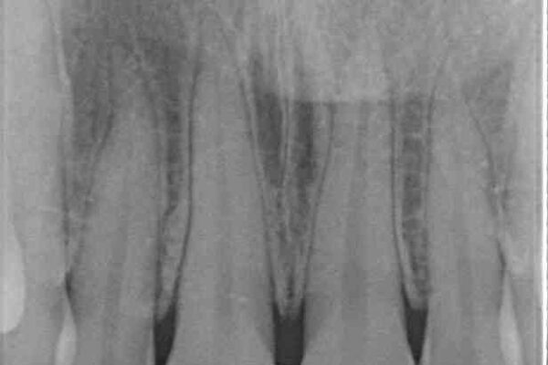 変色した前歯をオールセラミッククラウンに 治療前画像