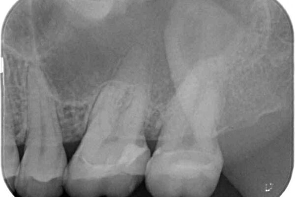 奥歯がズキズキと痛む　奥歯の虫歯治療 治療前画像