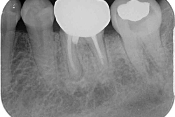むし歯で歯茎から血が出てくる　オールセラミッククラウンでの補綴治療 治療後画像