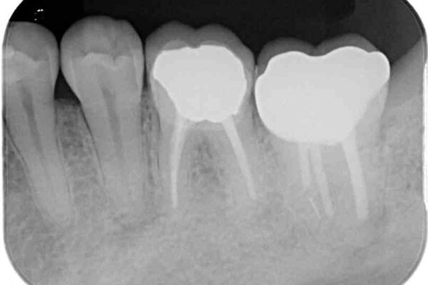 海外赴任前に治したい　割れてしまった奥歯のオールセラミッククラウン 治療後画像