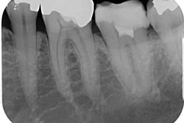 治療をしても違和感の続く奥歯　神経を極力残した虫歯治療 治療途中画像