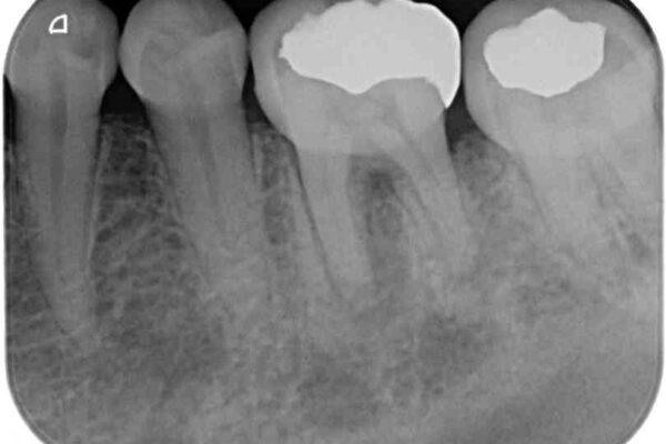 むし歯で歯茎から血が出てくる　オールセラミッククラウンでの補綴治療 治療前画像