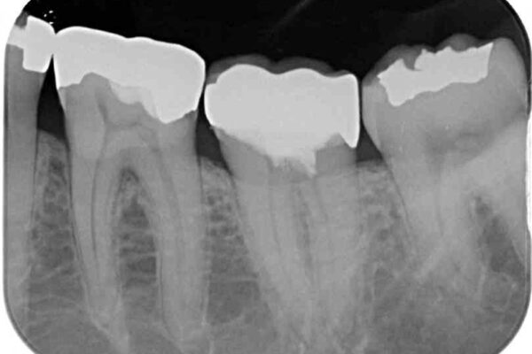 治療をしても違和感の続く奥歯　神経を極力残した虫歯治療 治療後画像