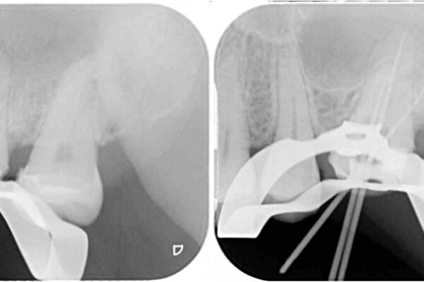 奥歯がズキズキと痛む　奥歯の虫歯治療 治療途中画像