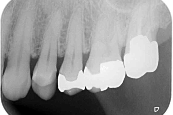 外れてしまった銀歯　セラミックインレーで自然な仕上がりに 治療前画像